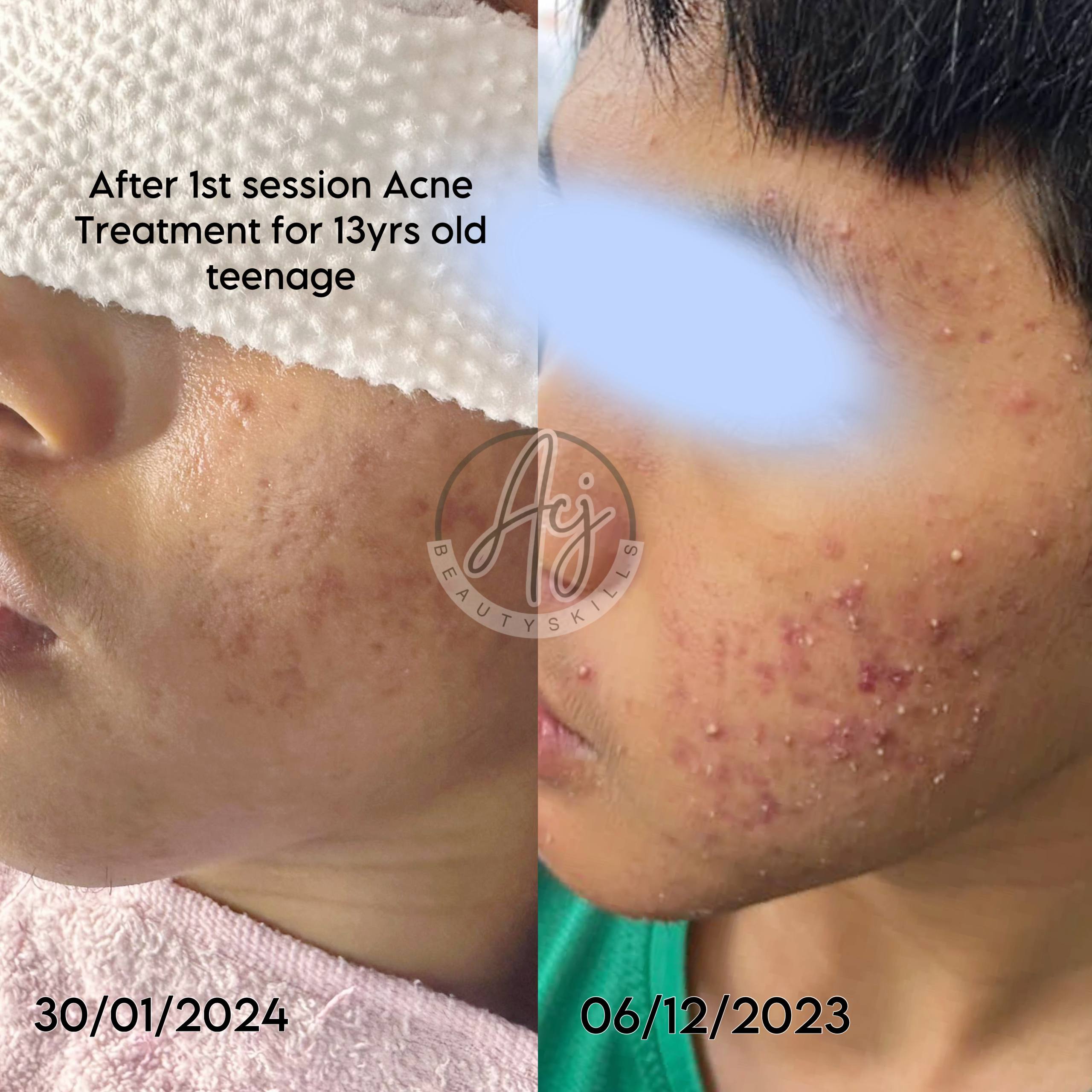 ACNE FACIAL
