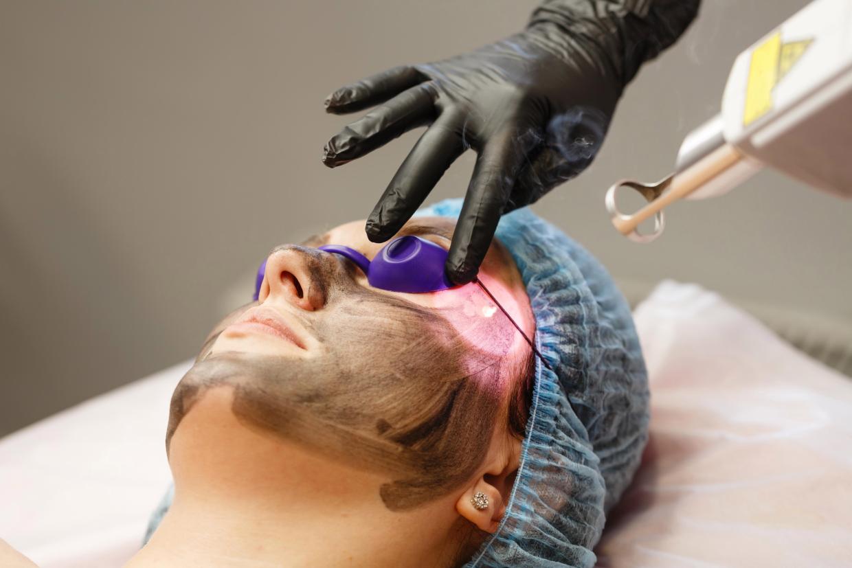 PICO TONING & CARBON LASER FACIAL